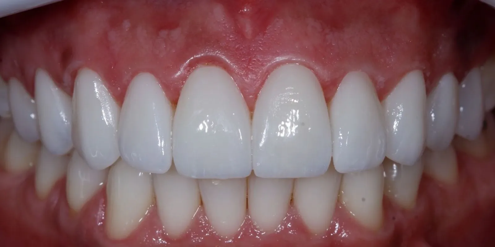 Sorriso com reabilitação estética, depois do tratamento