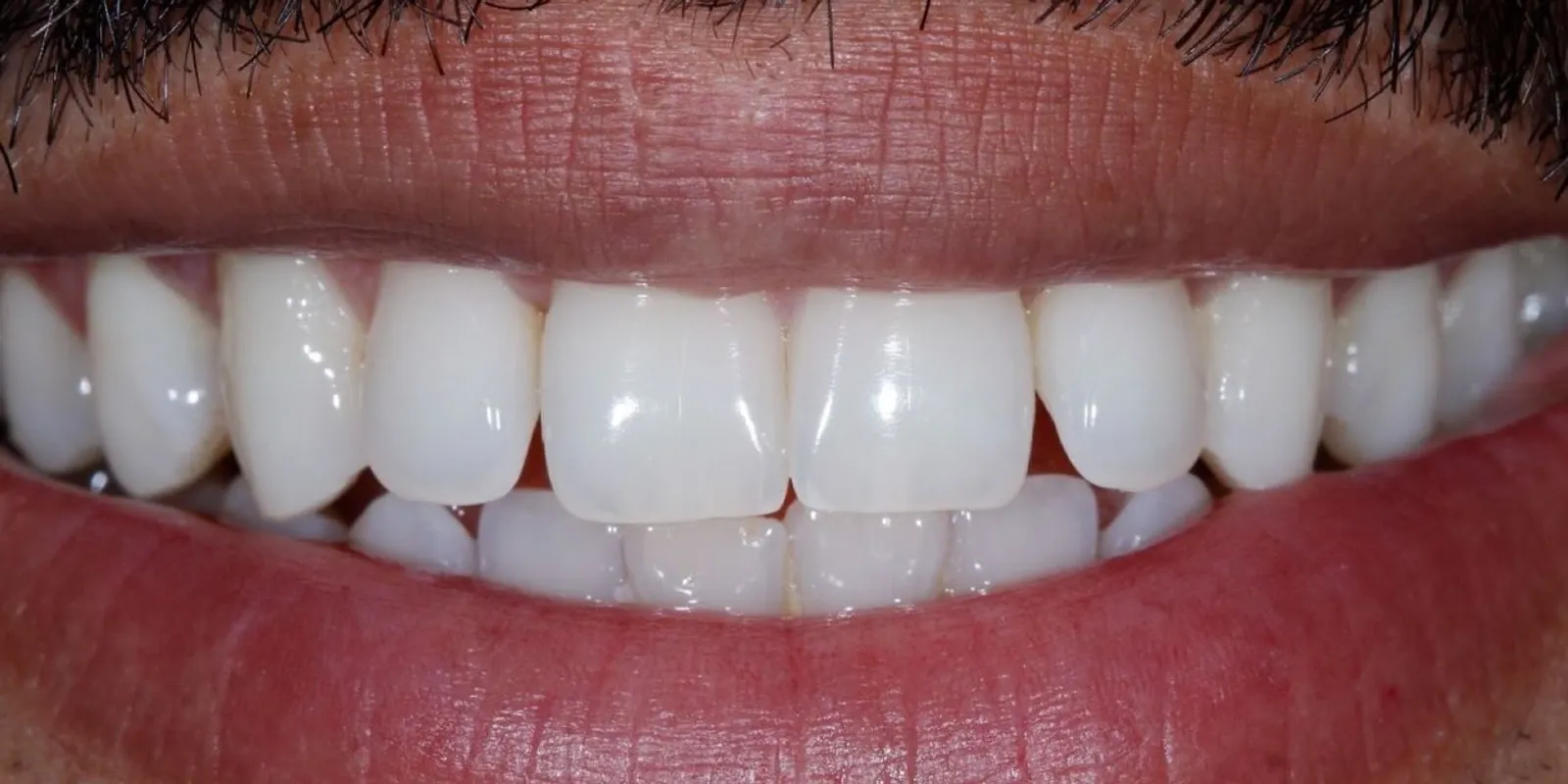 Sorriso com reabilitação estética, antes do tratamento