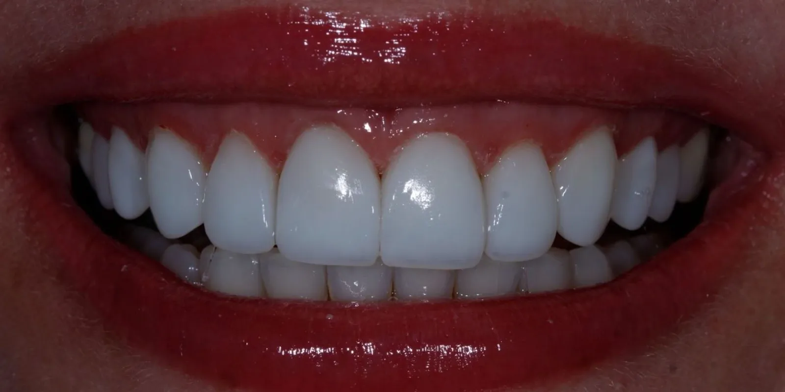 Sorriso com planejamento estético, depois do tratamento