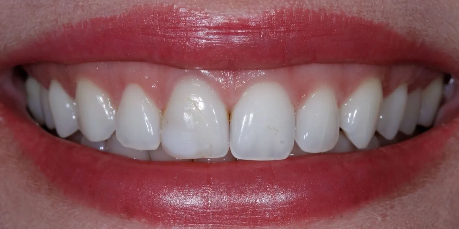Sorriso com planejamento estético, antes do tratamento