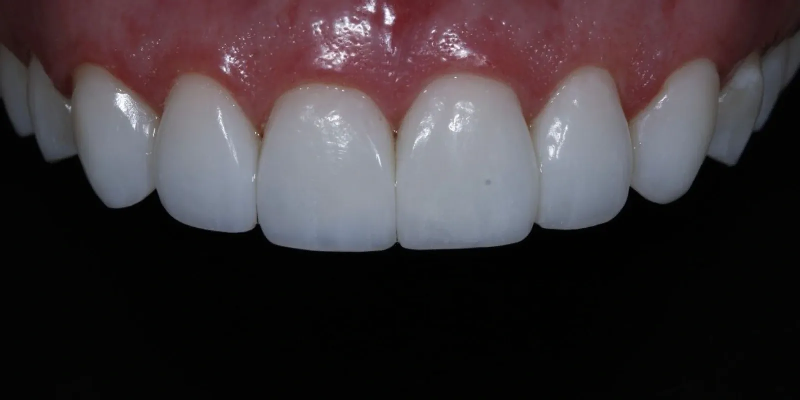 Restauração dos dentes anteriores, depois do tratamento