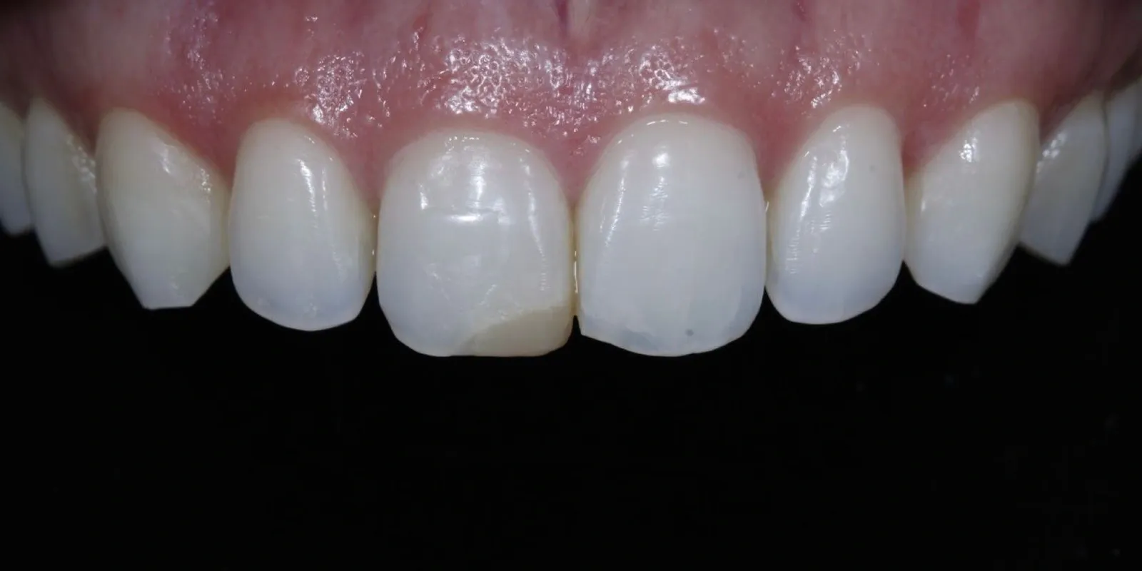 Restauração dos dentes anteriores, antes do tratamento