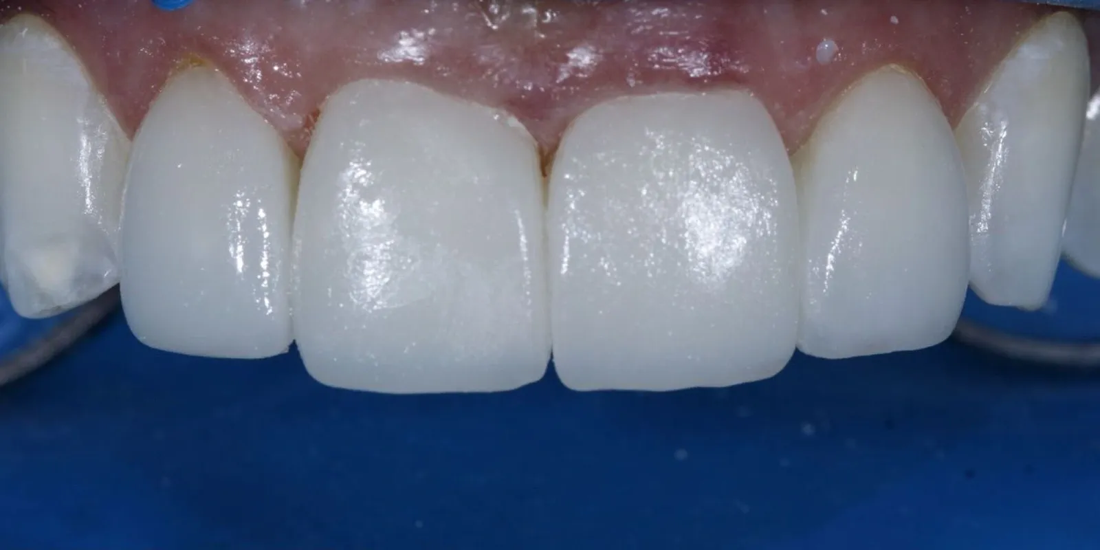 Detalhes da reabilitação dos dentes anteriores, depois do tratamento