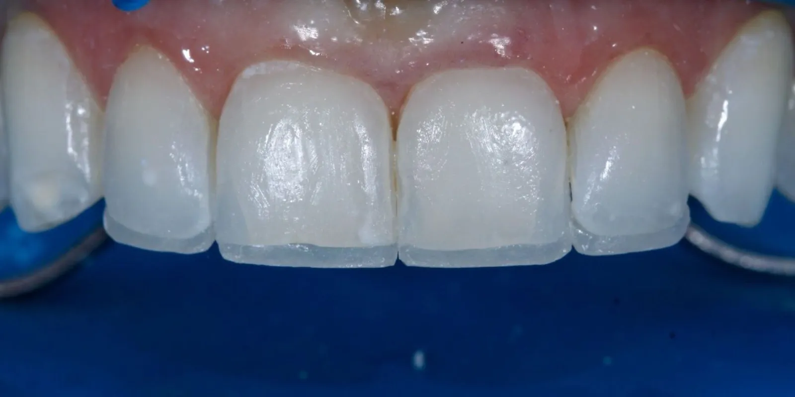 Detalhes da reabilitação dos dentes anteriores, antes do tratamento